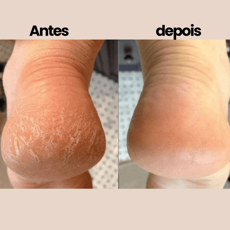 Removedor de Calos e Rachaduras Nuver® : Lixa Pedicure Automática| LIMPA ESTOQUE