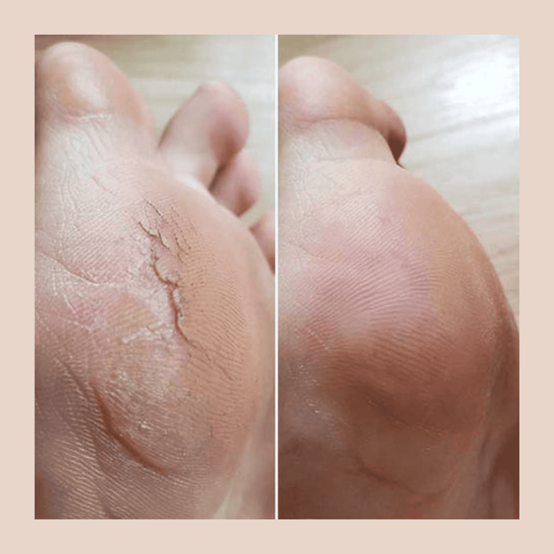 Removedor de Calos e Rachaduras Nuver® : Lixa Pedicure Automática| LIMPA ESTOQUE